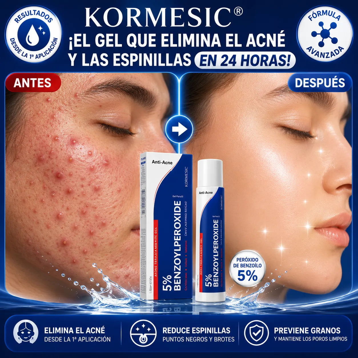 Kormesic® — ¡El gel que elimina el acné y las espinillas en 24 horas!